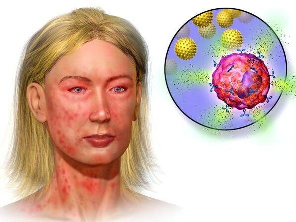 echinokokai ir jų buvimo organizme simptomai